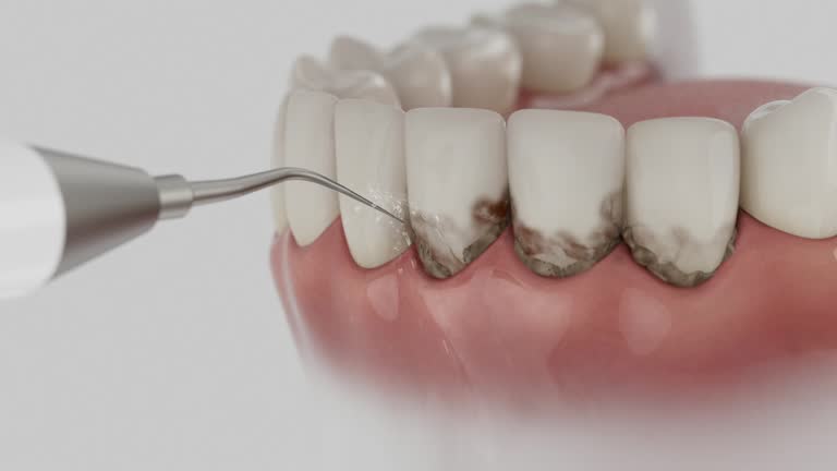 Trusted Wisdom Tooth Removal service in Mora, MN - Dentist Open Now
